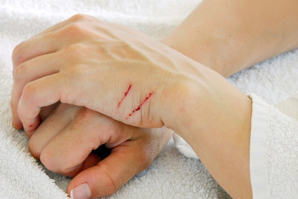 被猫咪抓伤用肥皂水洗可以吗,被家猫抓伤需要用肥皂水洗吗