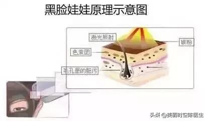 脓包黑头处理,处理粉刺黑头