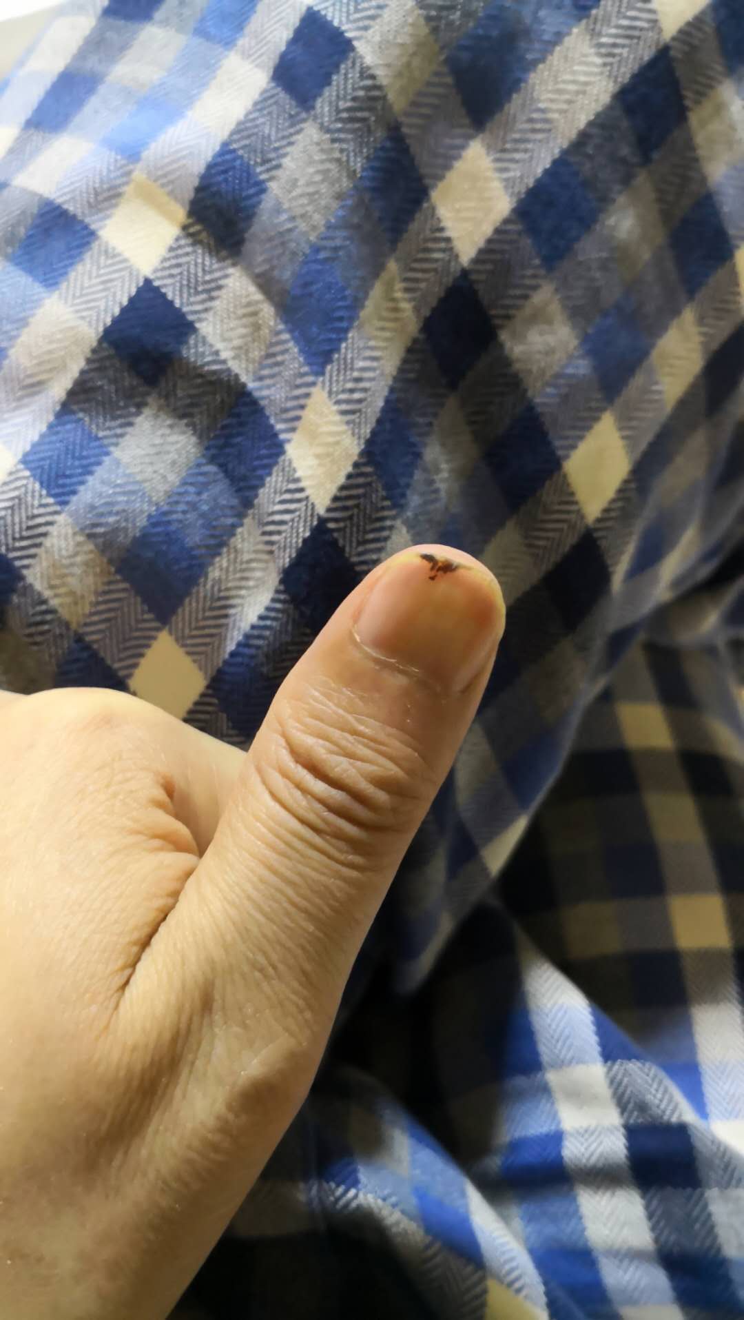 被压坏的指甲生长过程,摔倒就掉指甲是怎么回事