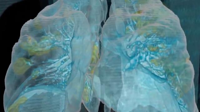 新冠病毒染到肺还会好吗,欧洲新冠感染者治愈后后遗症