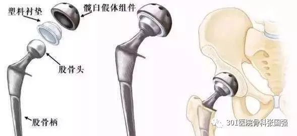 先天性髋关节脱位可以顺产吗,先天性髋关节脱位手术费多少