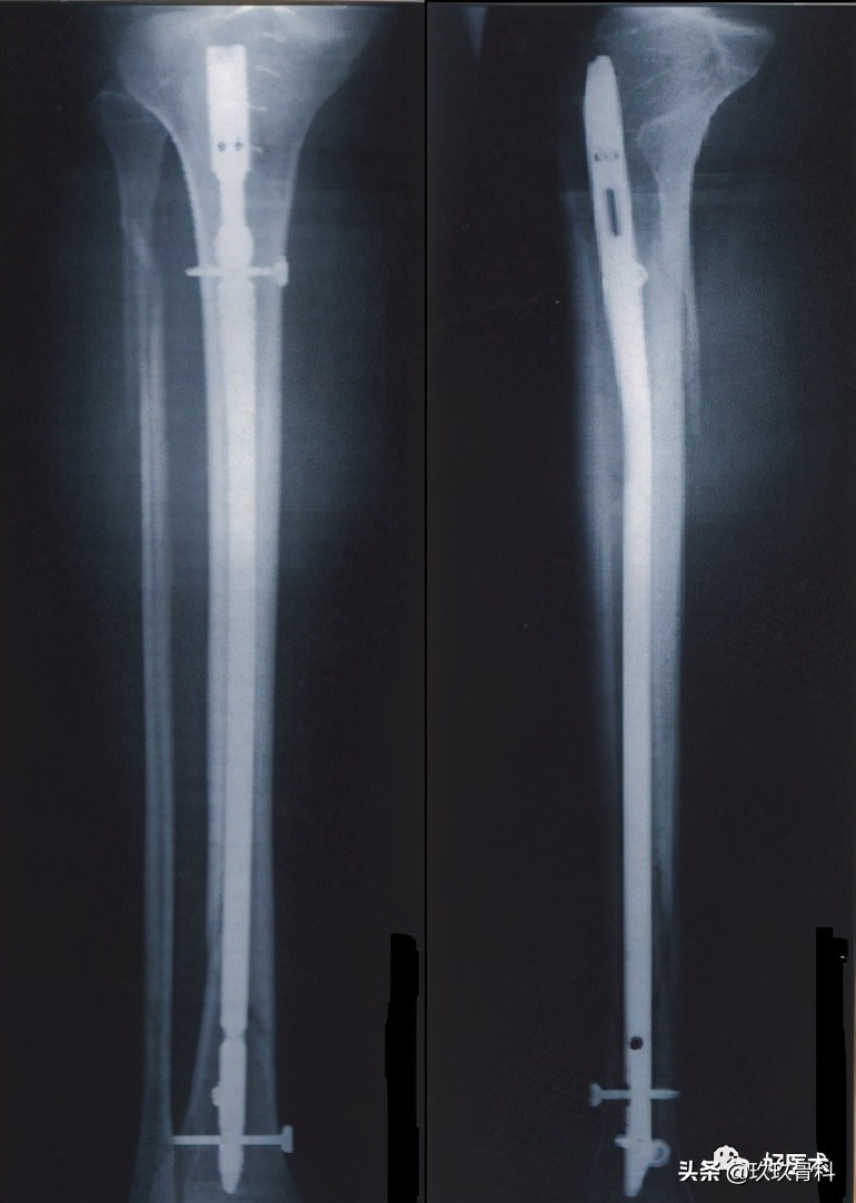 髓内钉技巧,髓内钉教学视频讲解