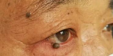 眼整形常见手术方式,眼整形美容手术