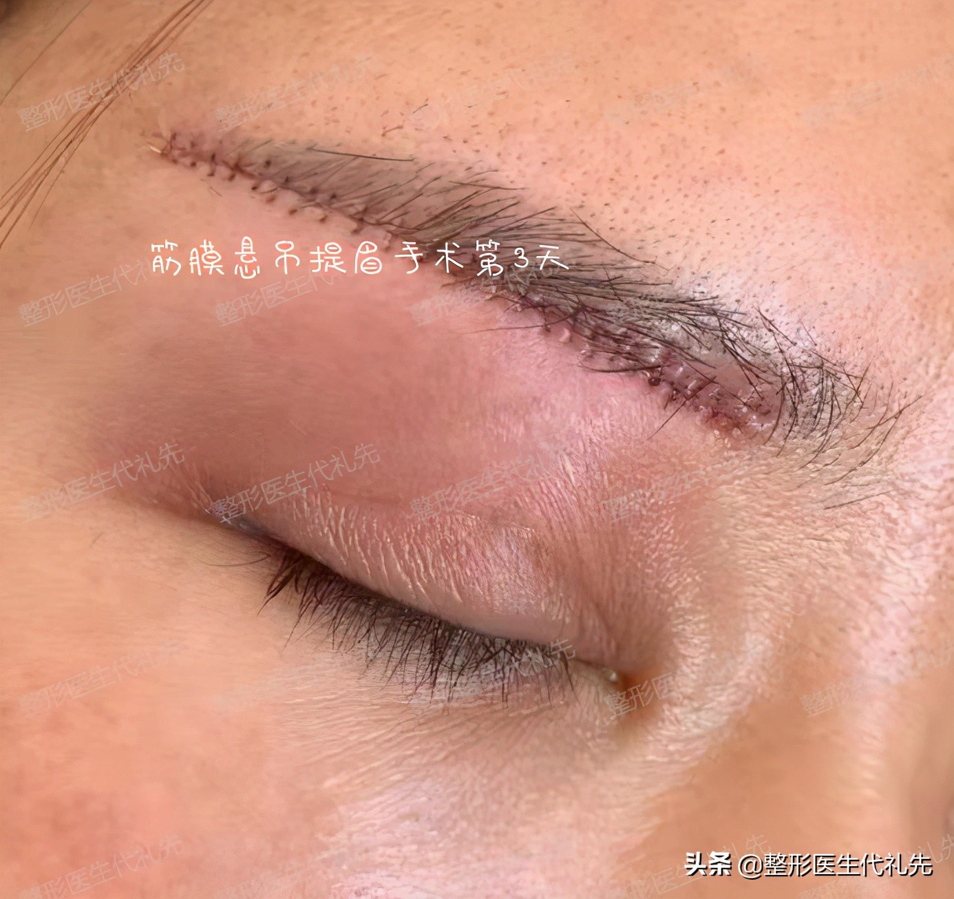 提眉手术的说法,提眉整形问答