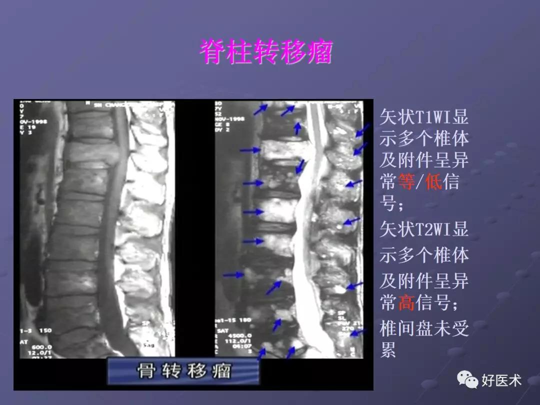 脊柱mri有哪些特点,乳腺疾病的mri诊断及鉴别