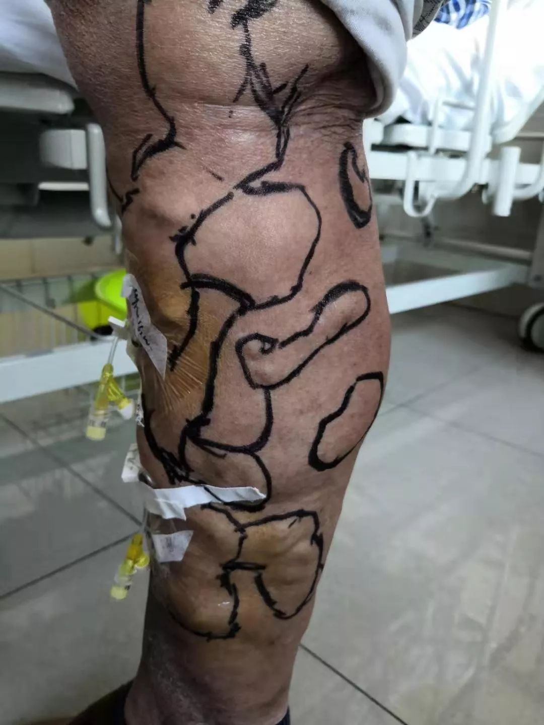 血管外科静脉曲张科普,静脉曲张病历案例