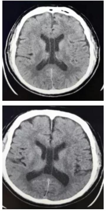 脑室透明隔间腔,第五脑室是什么意思