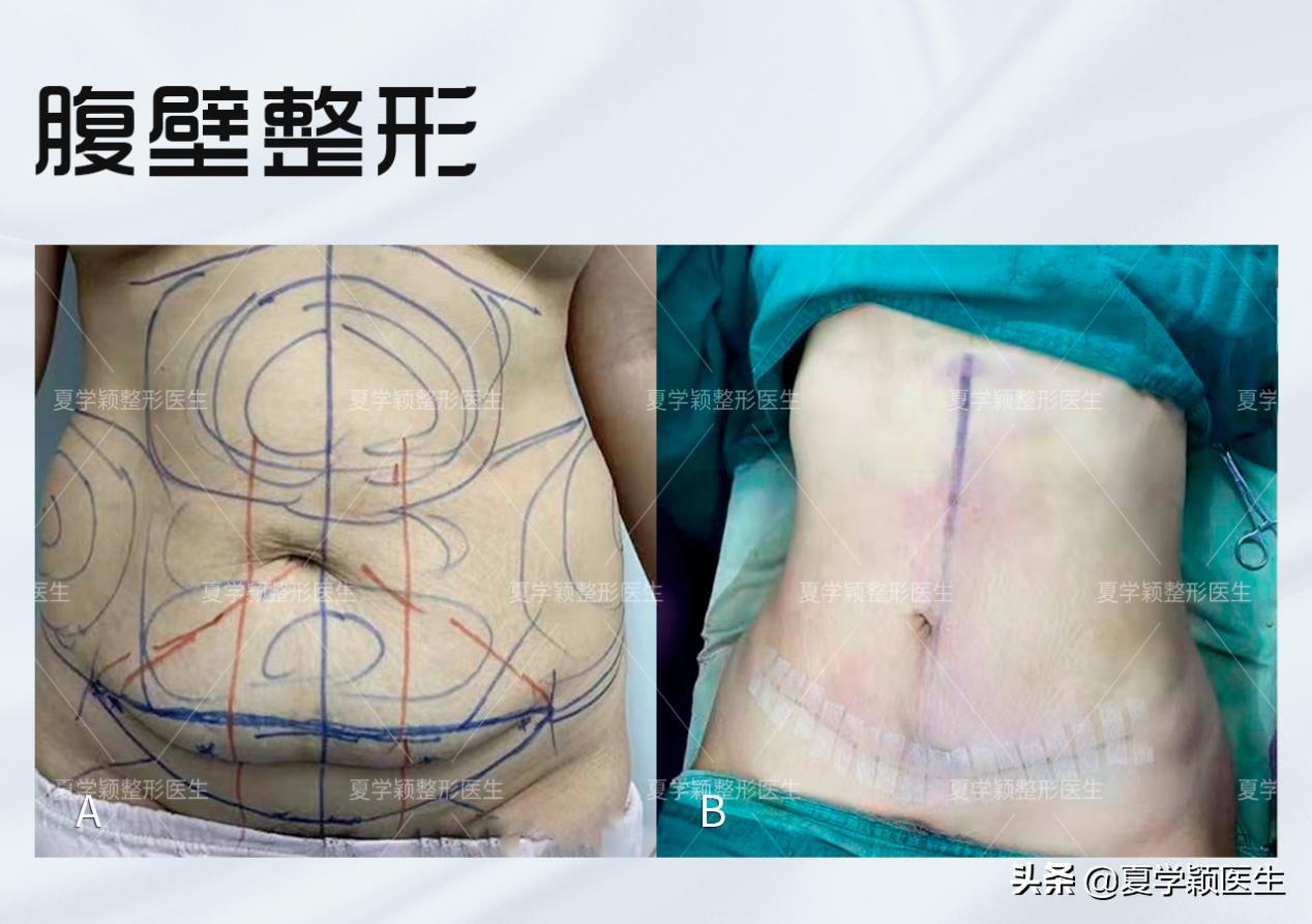 减肥成功后腹部下垂怎么办,减肥后腹壁松弛怎么办