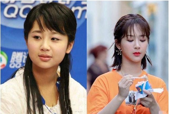 哪个明星做了颧骨内推,颧骨内推明星前后对比