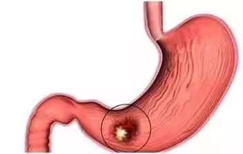 癌症不等于死刑！权威肿瘤医生的8条抗癌建议值得收藏