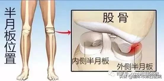 内侧半月板后角损伤怎么治疗,prp治疗半月板损伤有用吗