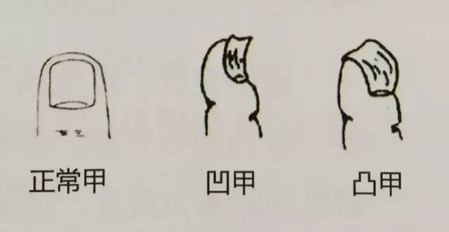 指甲有四种现象很危险,指甲反映身体状况
