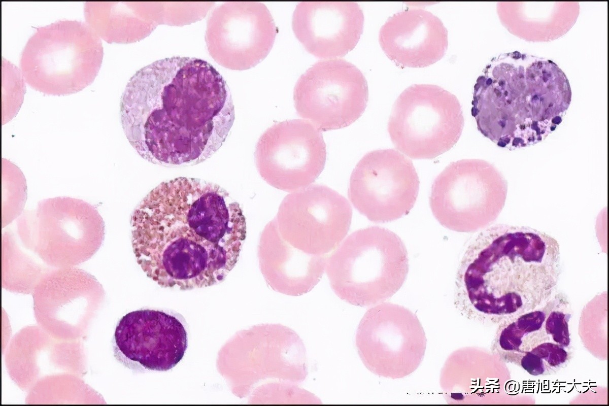 血常规白细胞高10.85有什么危害,血常规白细胞过低是什么意思