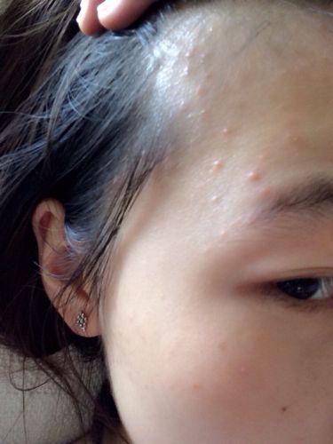 皮肤长出来小疙瘩是什么,皮肤上长了一个小疙瘩看什么科