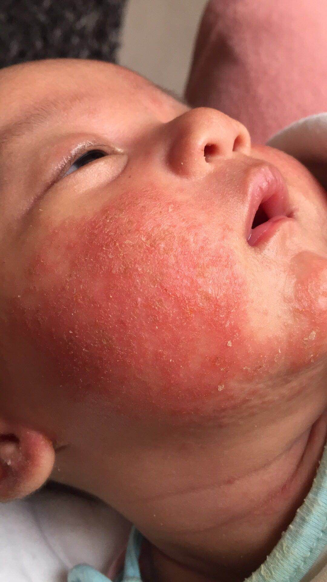 普及！宝宝湿疹不敢用药怕激素？湿疹护理指南来帮你