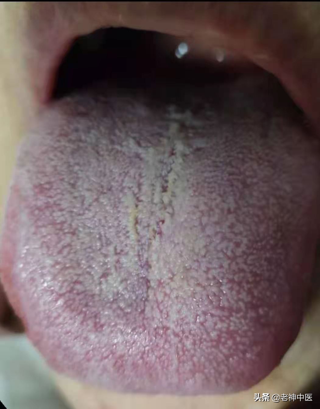 老人支气管肺炎咳嗽特效药,老人肺炎咳嗽痰多有什么特效药