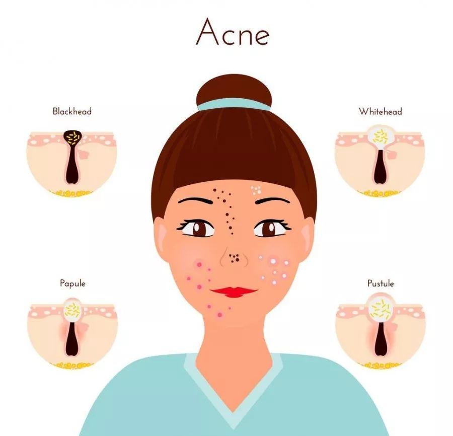 嘴巴周围长痘痘吃什么药,长痘痘怎么办最有效