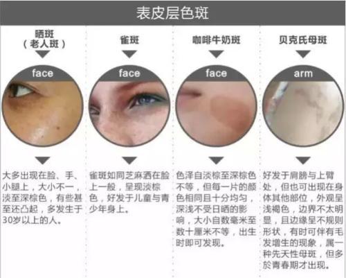 褐斑可以通过内调去掉吗,褐青色斑一个月去一次会怎样