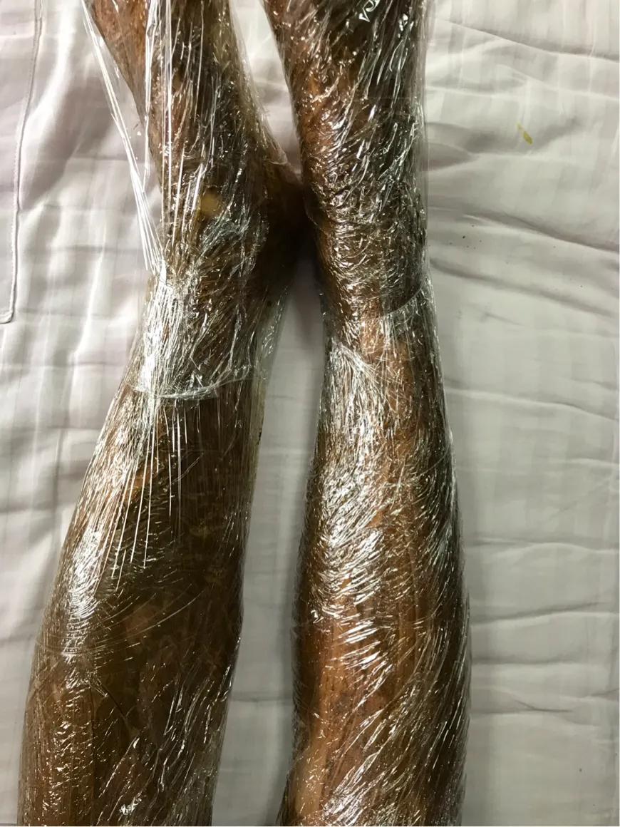 过敏性紫癜怎么治疗,过敏性紫癜