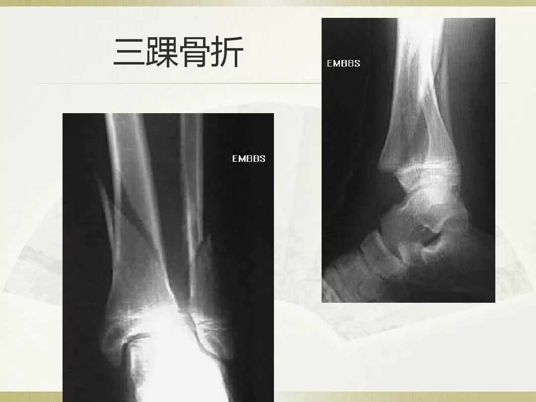 骨科x光片读片技巧,放射科骨科读片教程