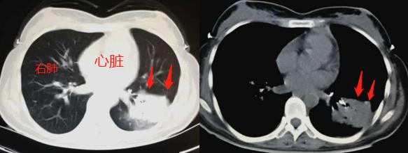 26岁确诊肺癌,26岁得了肺结核