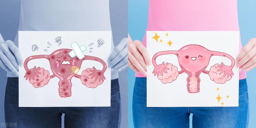 卵巢巧克力囊肿穿刺好还是手术好,巧克力囊肿穿刺后没有硬化