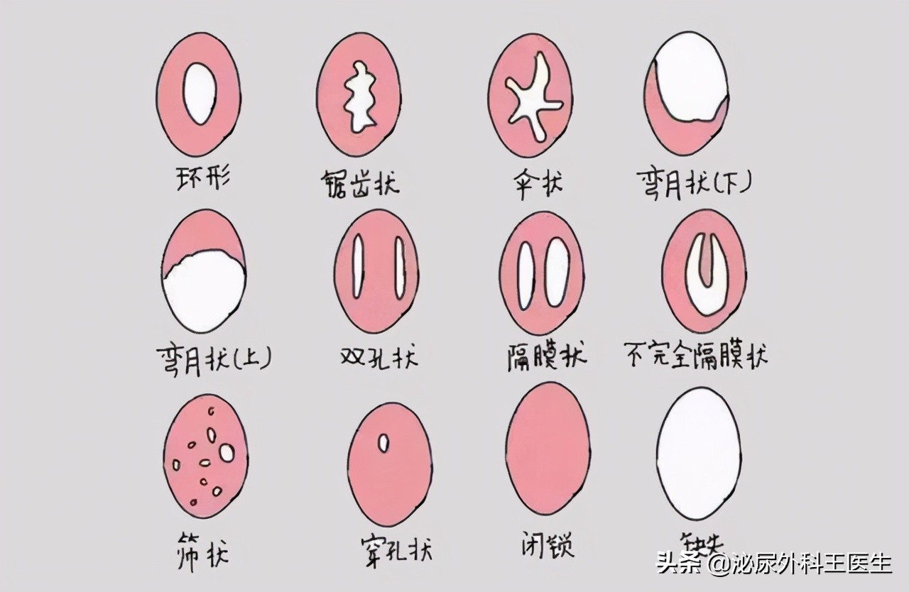 阴式b超检查前需要注意事项,什么是阴式b超检查