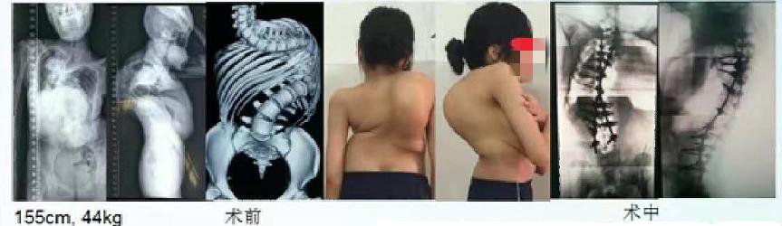 成人脊柱畸形矫形策略是什么,脊柱畸形医疗救治