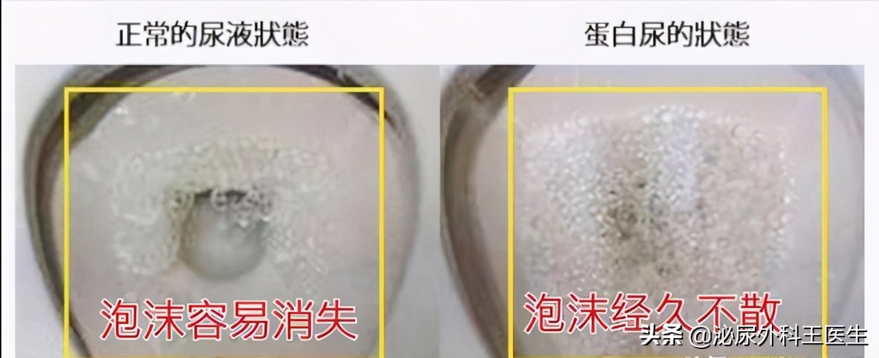 泡沫尿属于蛋白尿吗,泡沫尿是蛋白尿嘛