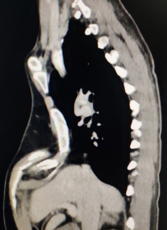 胸廓畸形矫正术后恢复,再创奇迹