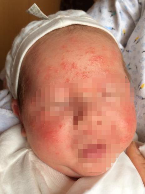 宝宝反反复复长痘痘怎么办,小宝宝常见病护理