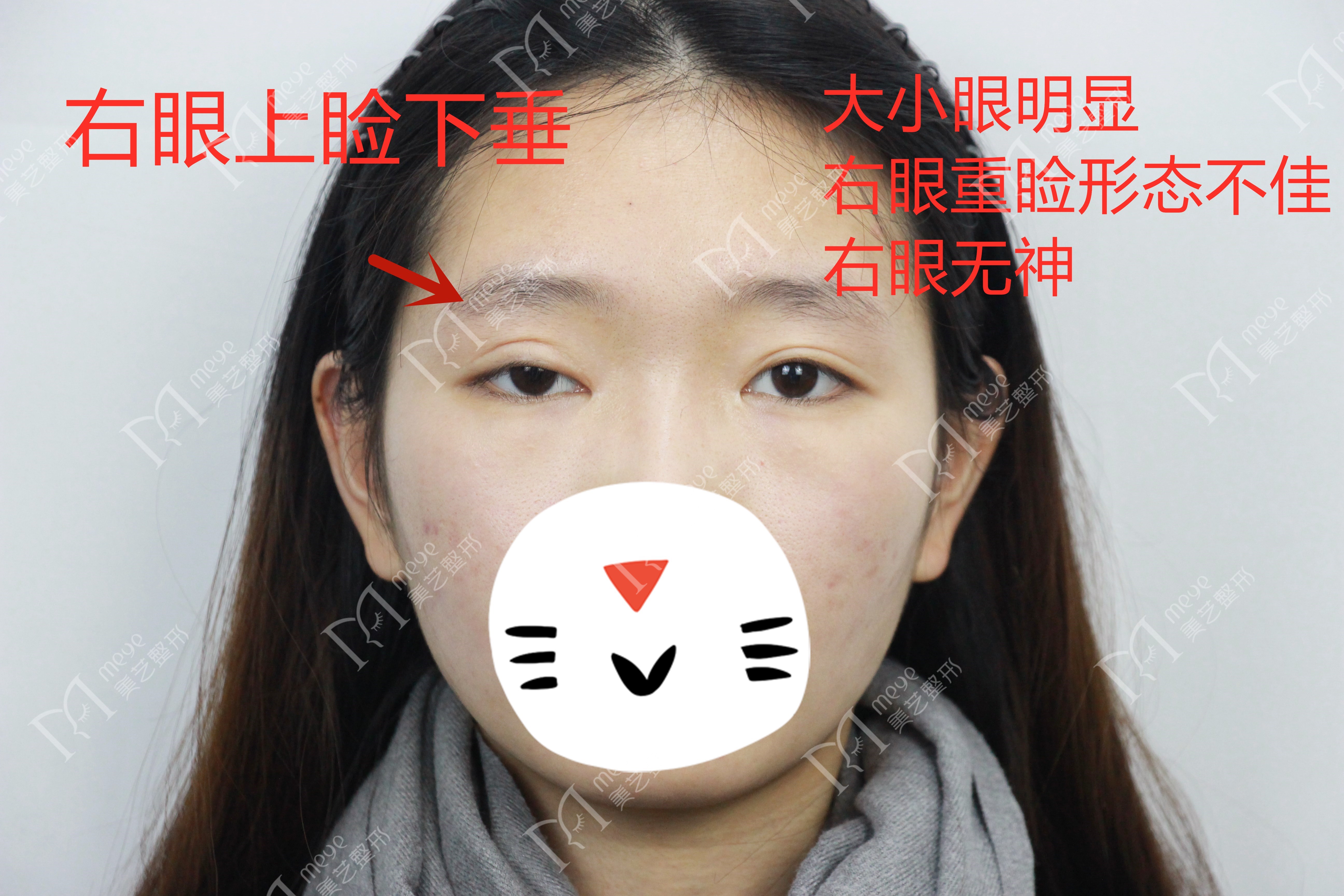 单眼上睑下垂修复术,上睑下垂眼睛修复手术成功率高吗