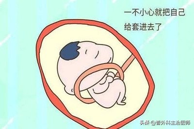 胎死宫内的刽子手-------脐带缠绕