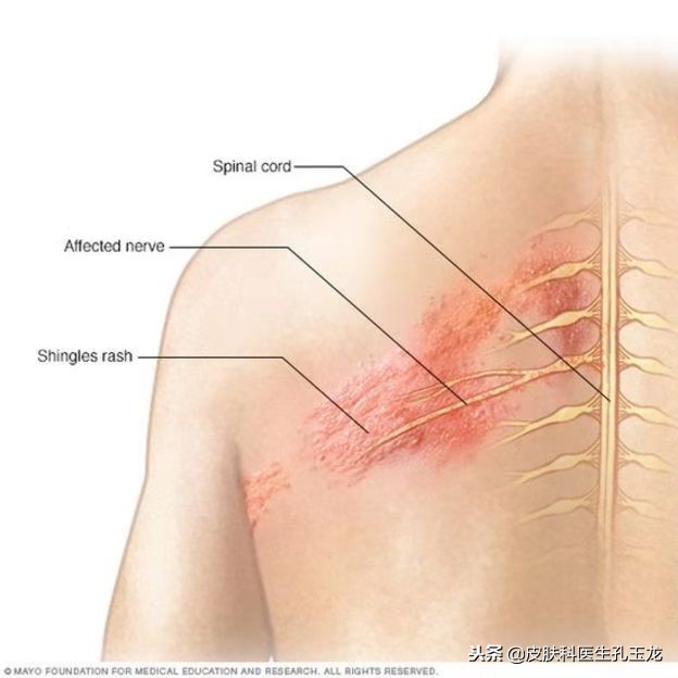 皮肤科常见疾病系列:带状疱疹后遗神经痛的治疗汇总