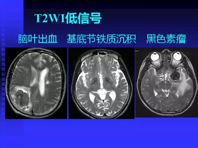 头颅mri读片视频教程,颅脑mri读片入门教程视频讲解全集