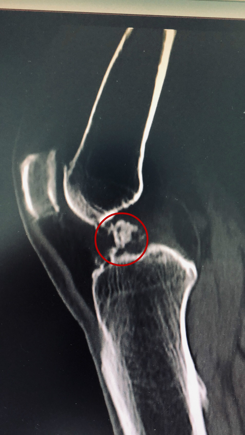 小石子卡肉里多久会愈合,小石子卡进脚里面怎么办