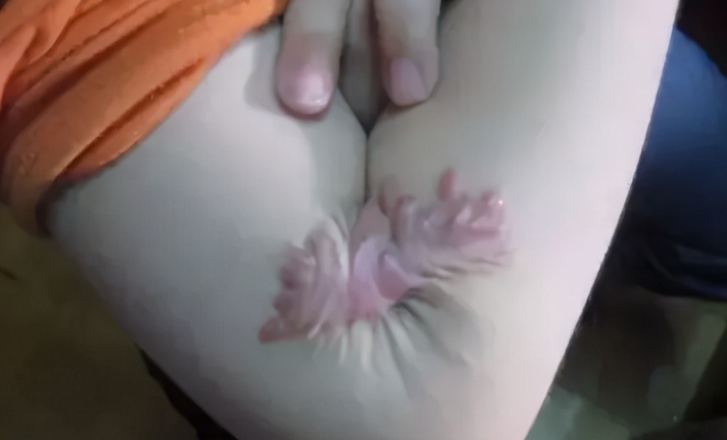 被火烫伤疤痕修复最好的方法,烧烫伤疤痕治疗的方法都有哪些