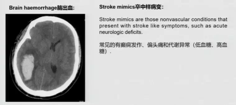 急性脑中风影像诊断选择,急性脑卒中首选哪种检查方法