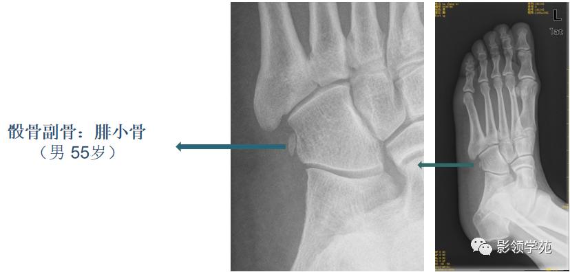 桡骨远端骨折引起尺骨变异,撕脱骨折一个月无明显骨痂形成