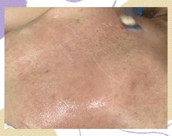 大痘印适合做什么医美,医美做什么可以去除痘坑