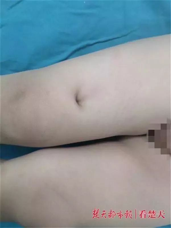 家中这些“杀手”一定要注意!2岁男孩腿上出现一凹陷的大洞