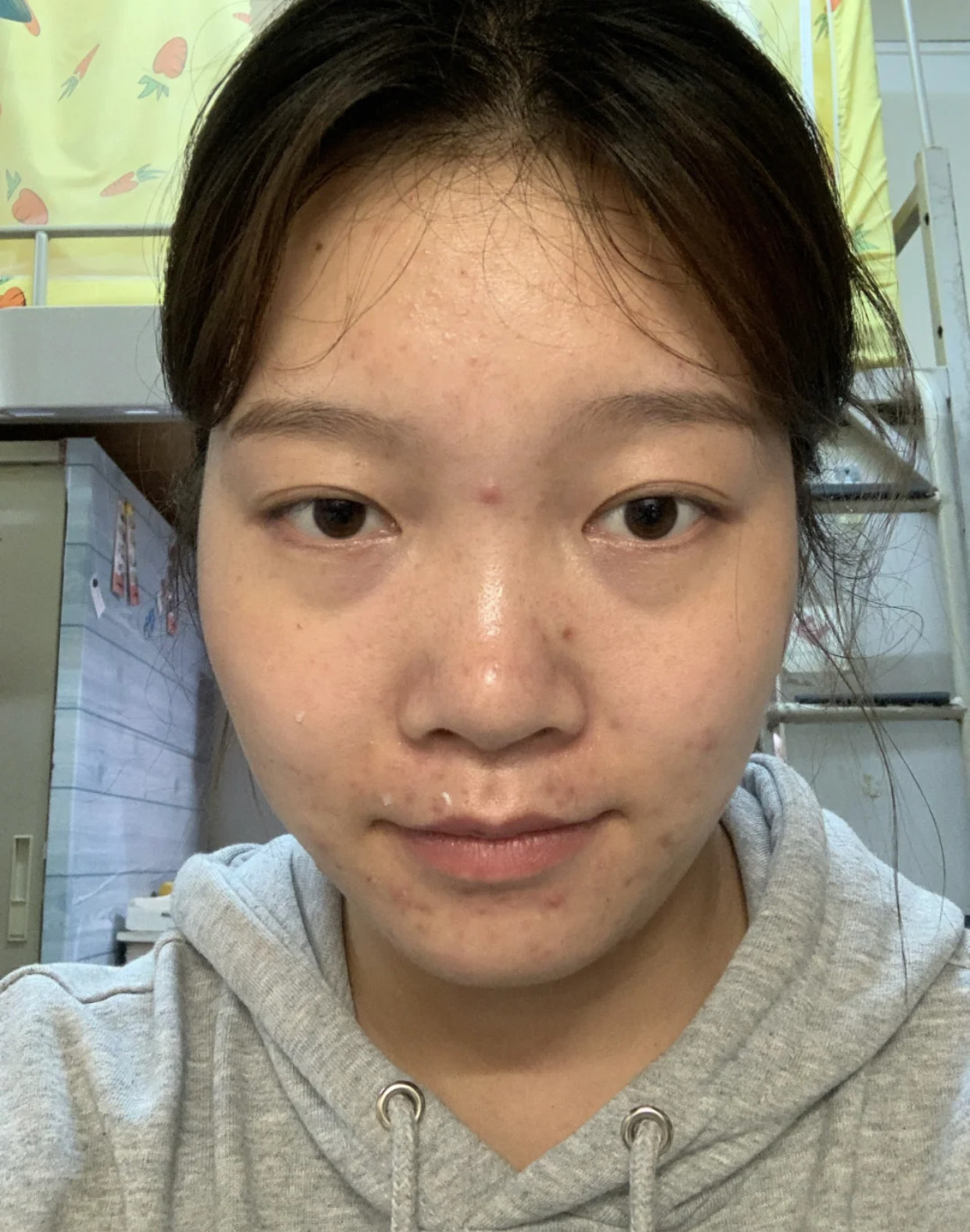 30岁之前不长痘30以后频繁长痘,30岁还一直长痘该怎么样护肤