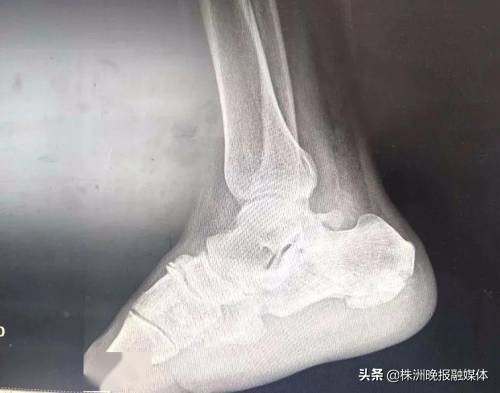 搬货扭伤了腰怎么处理,搬货砸伤脚