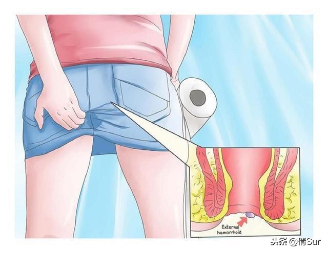 痔疮如何预防和缓解,怎么预防妊娠期痔疮加重