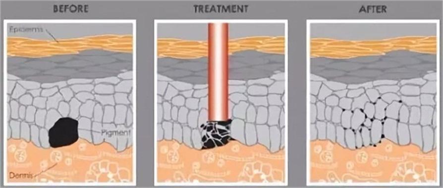 美容祛斑原来这么简单,祛斑算是整容吗