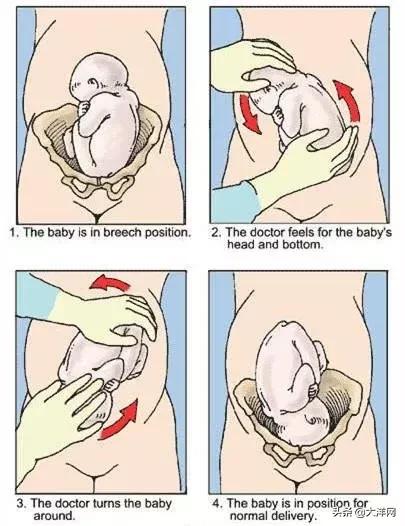 神奇1分钟!胎位不正医生隔着肚皮手动“大挪移”,剖转顺