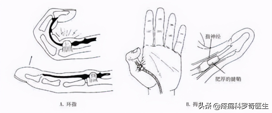 一岁半腱鞘炎最简单自愈方法,腱鞘炎小妙招一招摆脱困扰