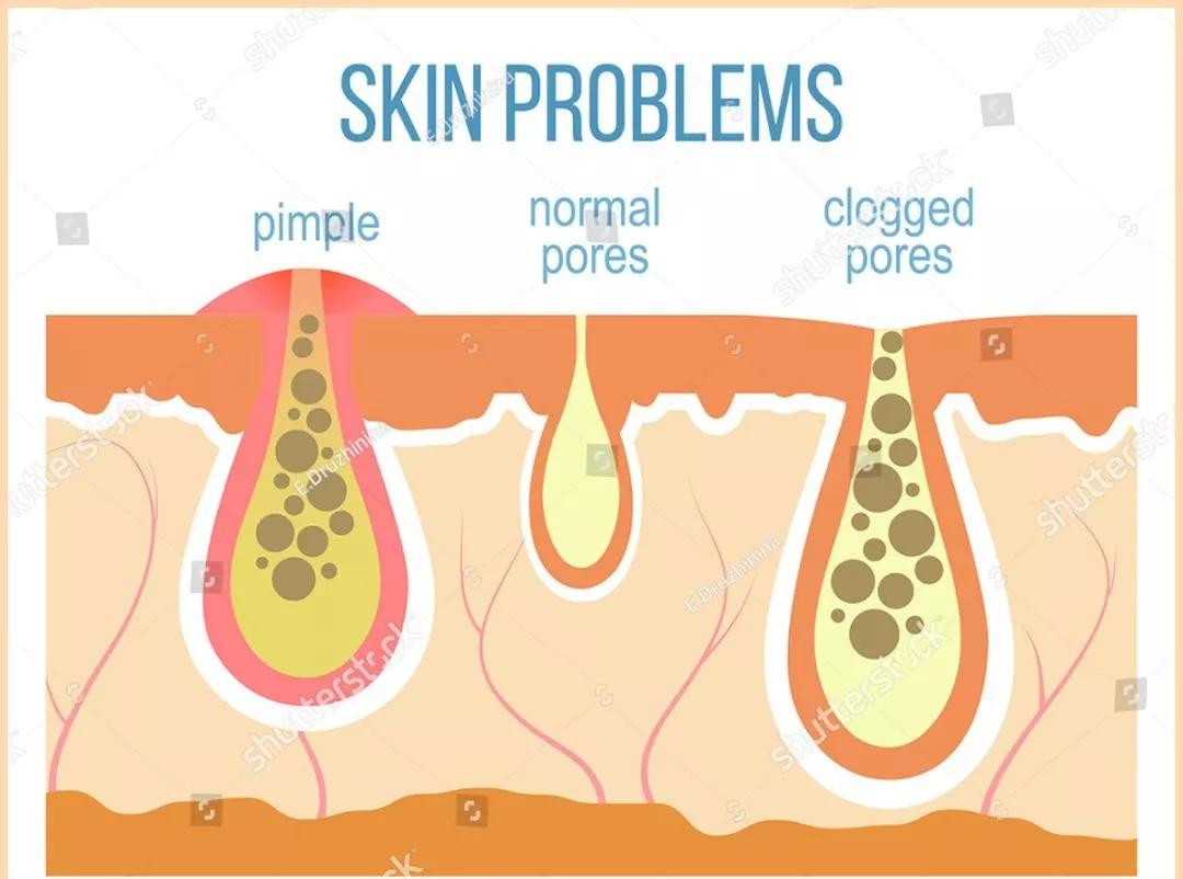 毛孔粗大如何改善治愈系,解决毛孔粗大最有效医美的方法