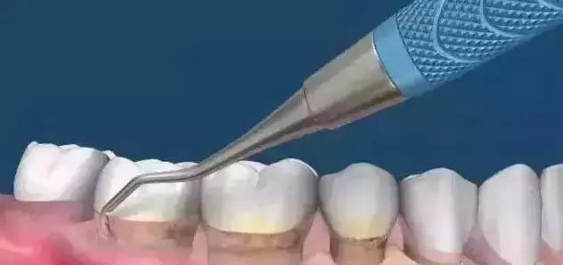 深度洗牙和普通洗牙,洗牙深度洁治和上药大概多少钱