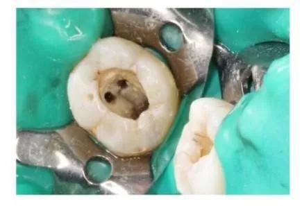 为什么牙疼起来真要命,牙疼不是病疼起来真要命